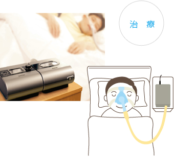 睡眠時無呼吸症候群　治療機器